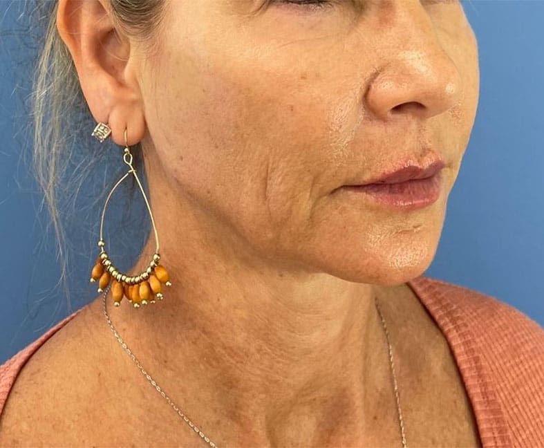 Cheek and Jaw Filler after