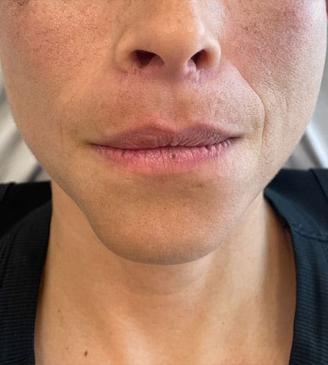 Lip Fillers before