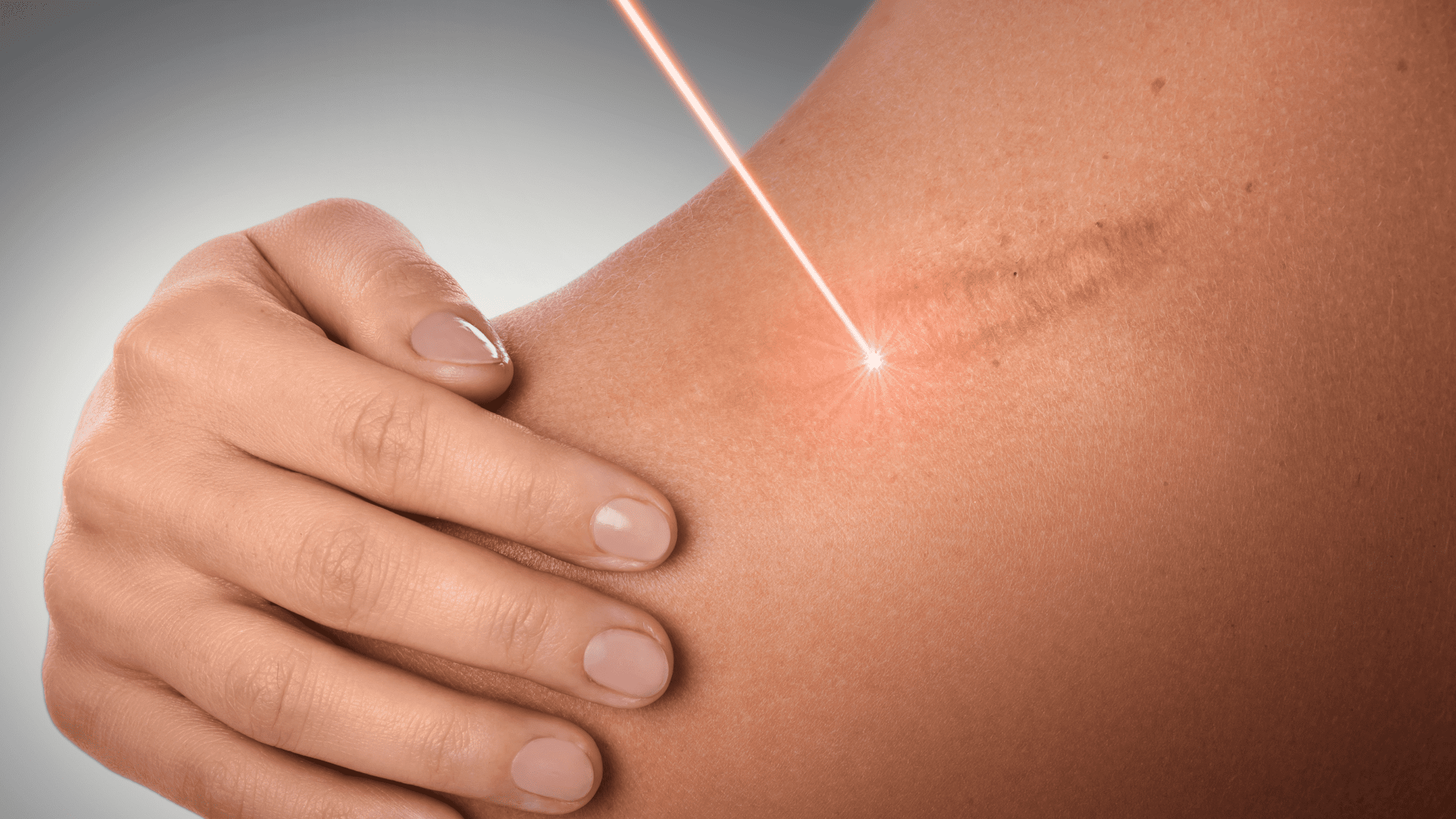 How Much Is Laser Scar Removal?