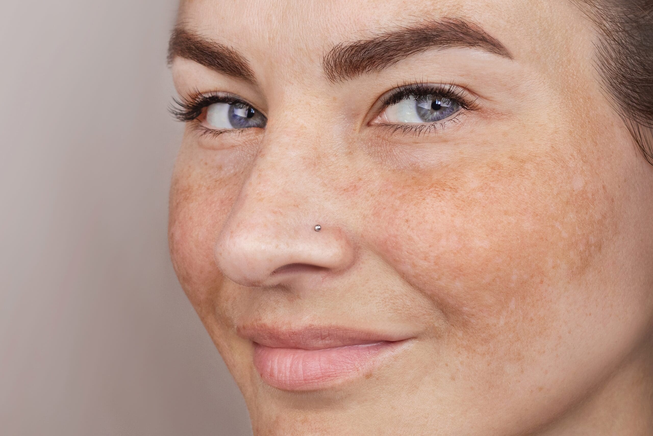 Freckles vs Sun Spots: What’s the Difference?