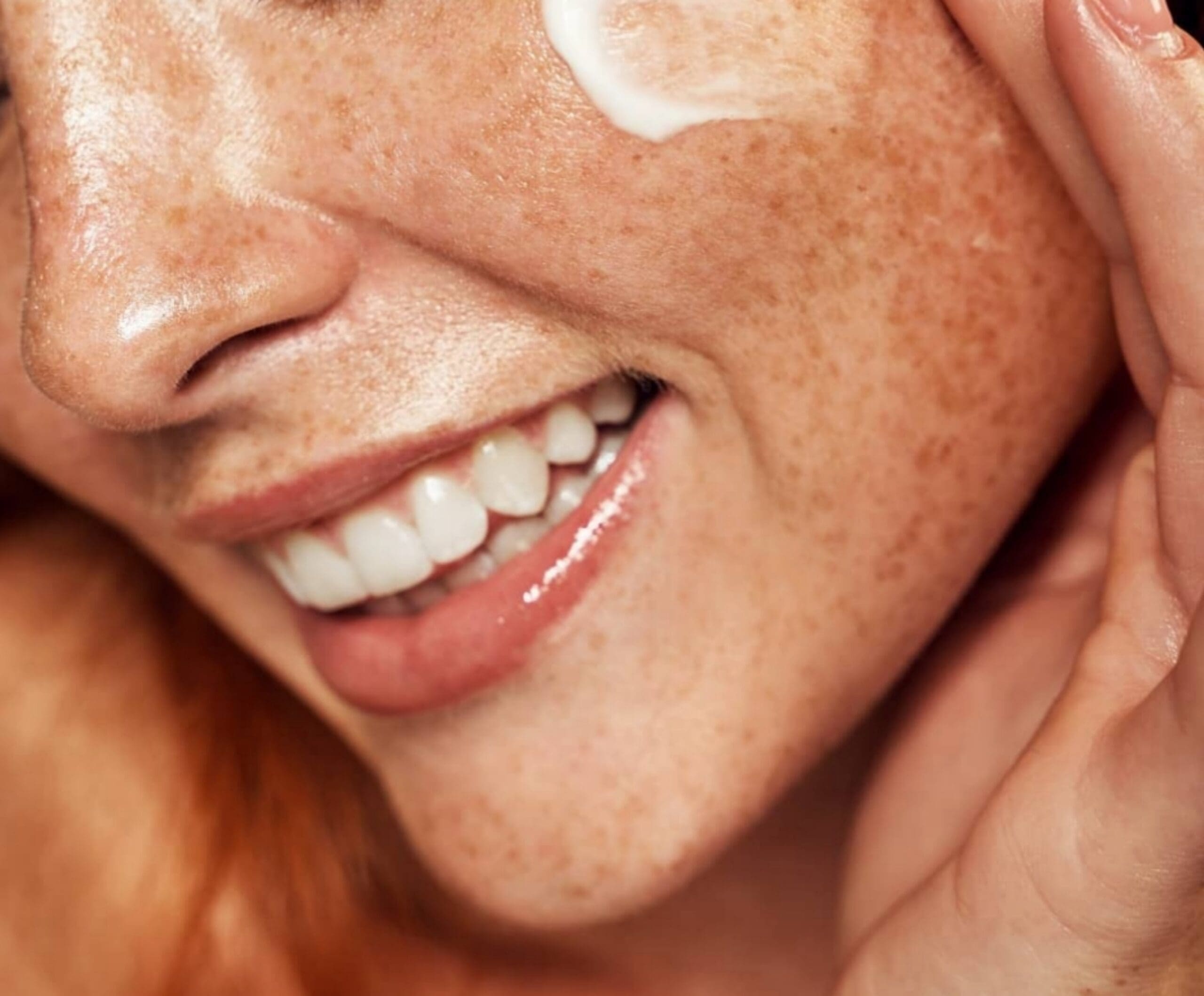 How Can I Remove Freckles Safely?