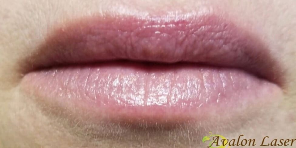 Lip Filler 1