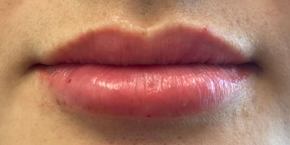 Lip Filler 2