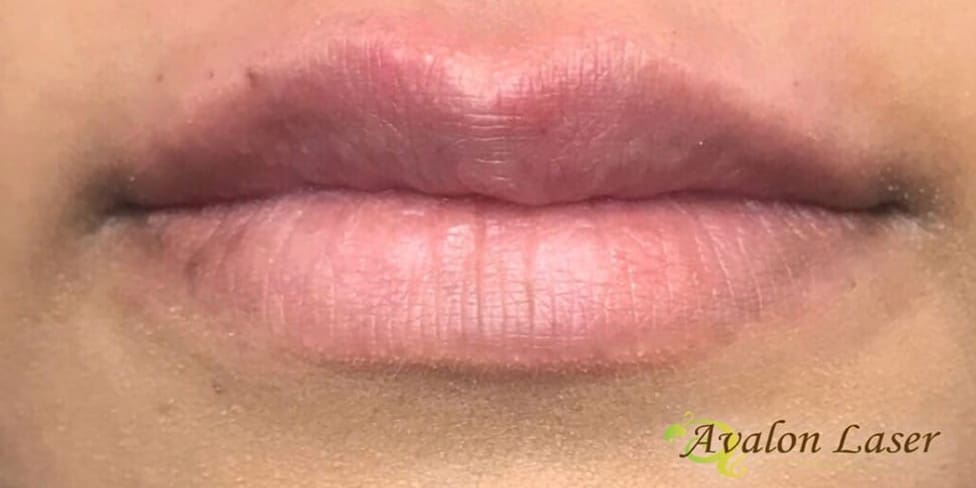 Lip Filler 3