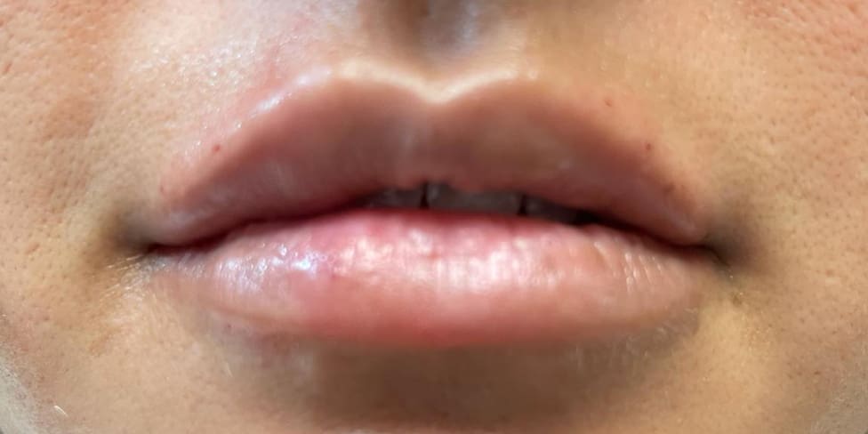 Lip Filler 4