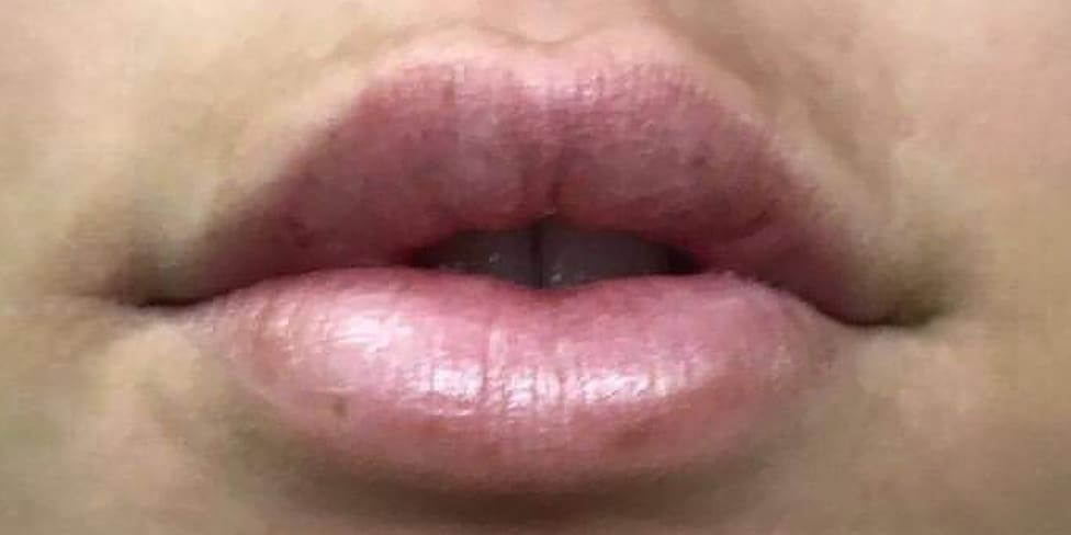 Lip Filler 5