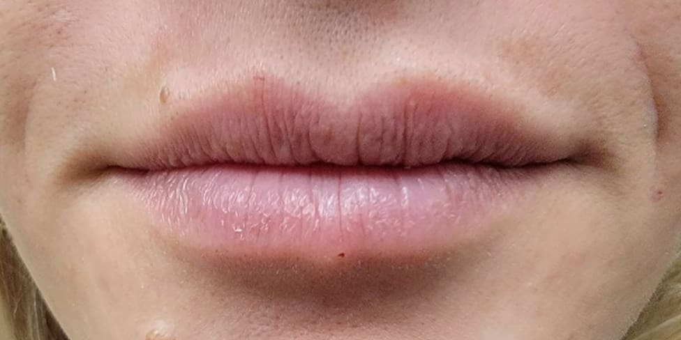 Lip Filler 6