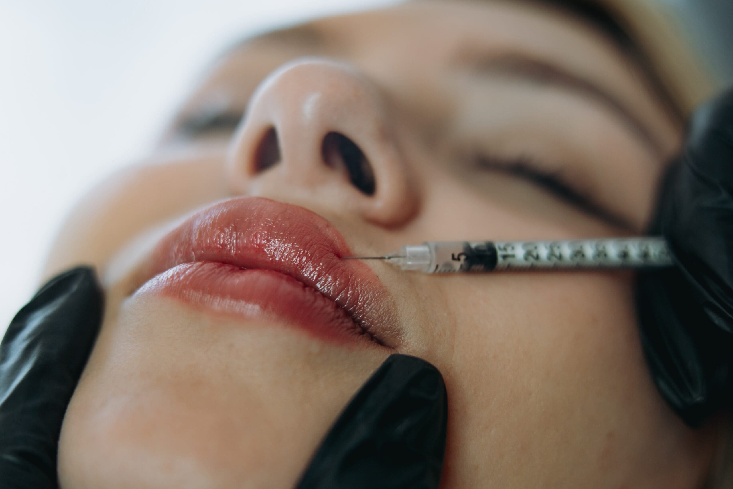 Lip Filler Dissolution Cost in San Diego, California